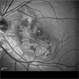 Macular Serpiginous Choroidopathy Macular Serpiginous Choroidopathy